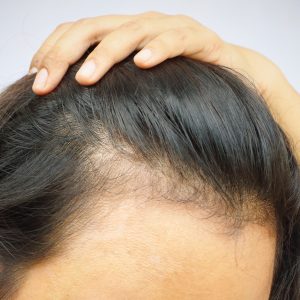 hair pieces for thinning hair