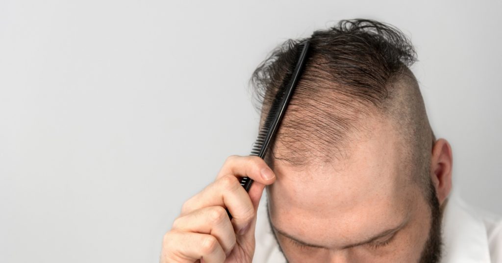 thinning hair