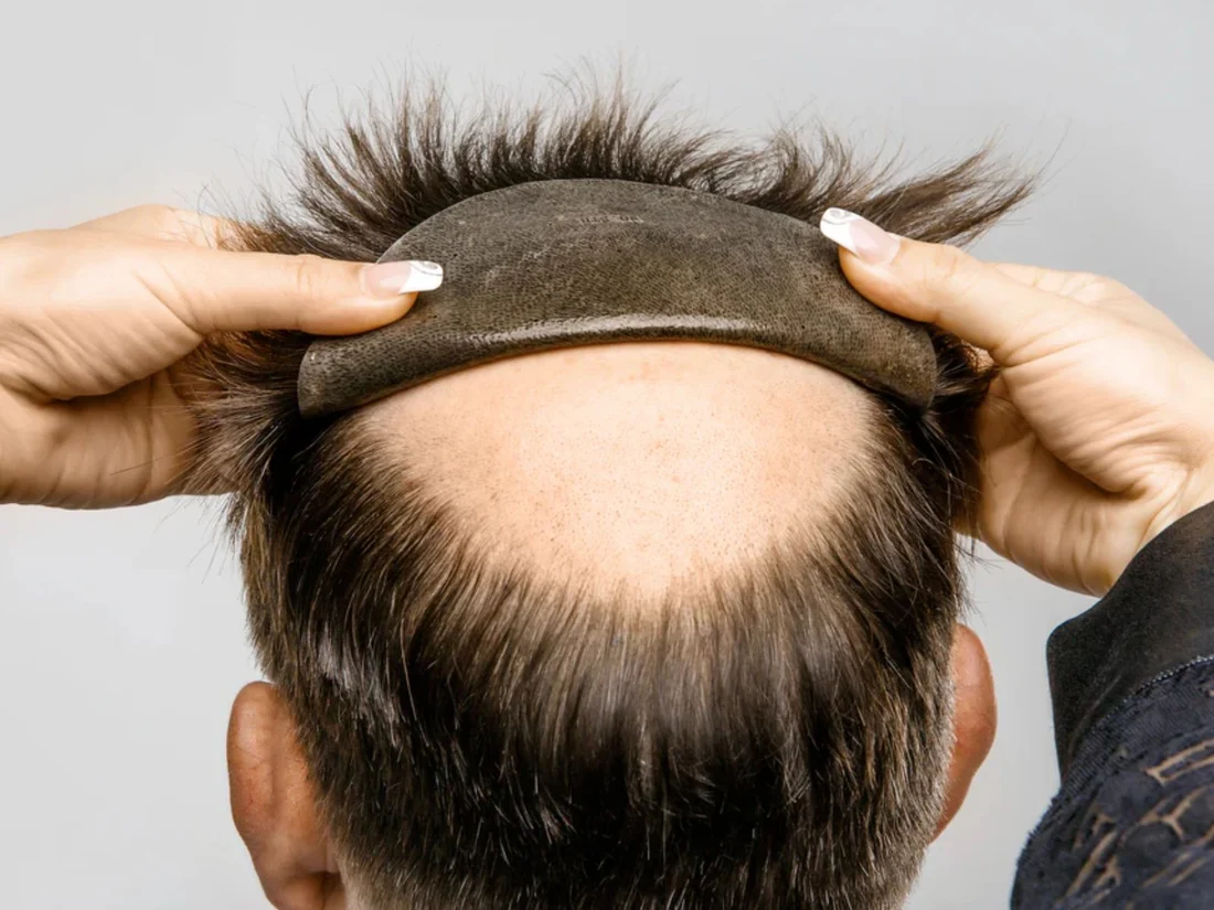 hair system