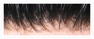 Hairline Img 2